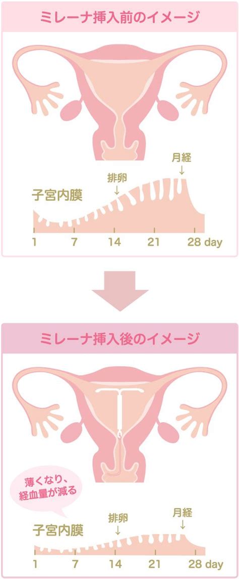 ミレーナ 中だし|【体験談】避妊リング（ミレーナ）を挿入して